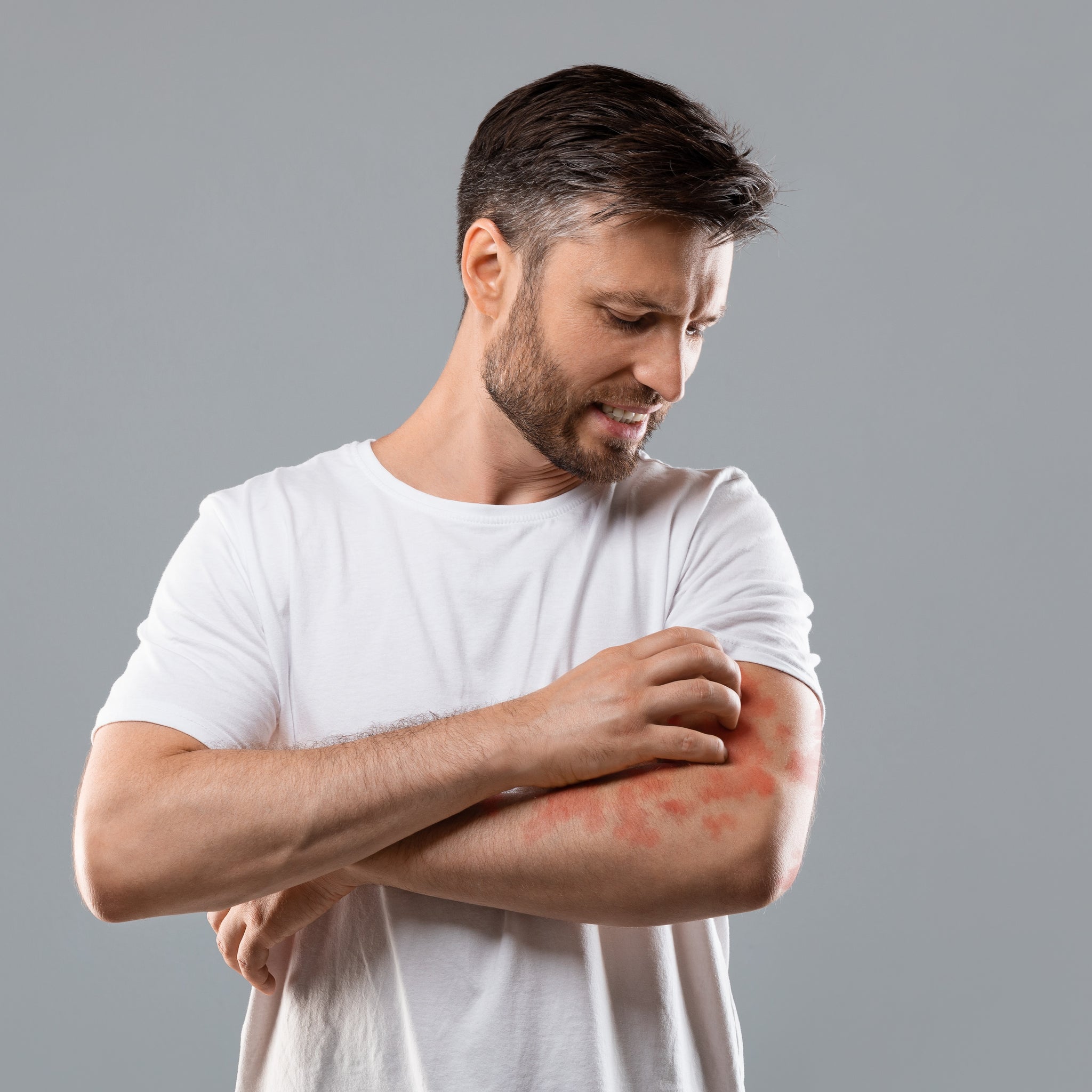 Peut-on traiter son psoriasis avec du CBD?