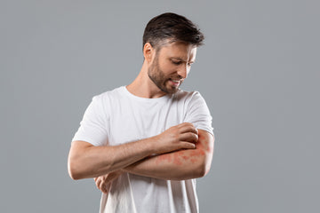 Peut-on traiter son psoriasis avec du CBD?